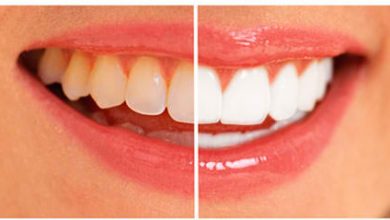 Photo of सुंदर और सफेद दांतो वाली मुस्कान की है चाहत, तो करें इन 3 चीजों का इस्तेमाल