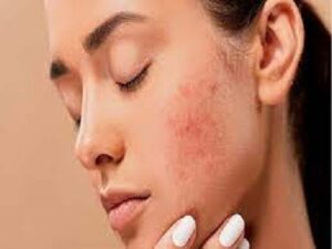 चेहरे की खूबसूरती बिगाड़ देते हैं मुहासे, छुटकारा दिलाने में मददागार होंगे ये उपाय “ • ˌ चेहरे की खूबसूरती बिगाड़ देते हैं मुहासे, छुटकारा दिलाने में मददागार होंगे ये उपाय “ • ˌ